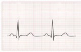 electrocardiograma con informe riesgo quirurgico prequirurgico ecg con informe